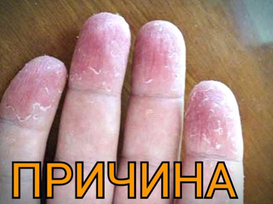 Аспект: Почему у моего ребёнка облазит кожа пальцев рук и ног?